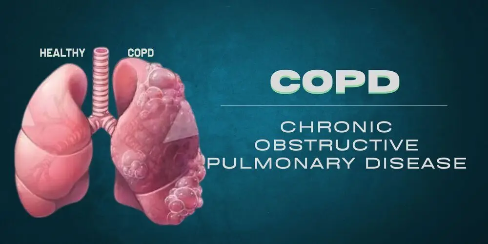 Understanding COPD: Causes, Symptoms, and Management