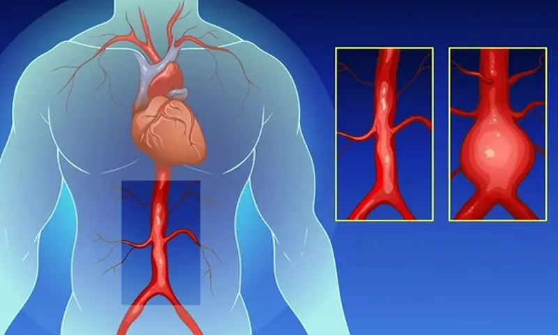 Aortic Aneurysm Repair 