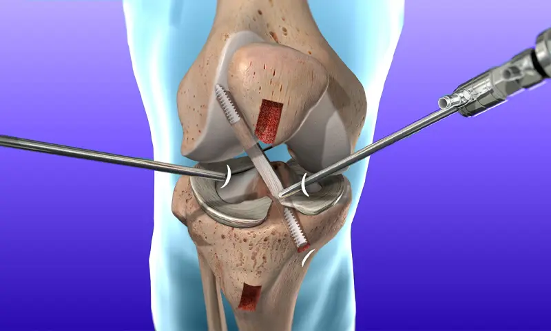 ACL Reconstruction Surgery 