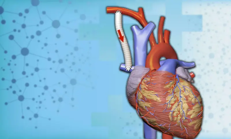 Blalock Taussig (BT) Shunt Surgery cost In India