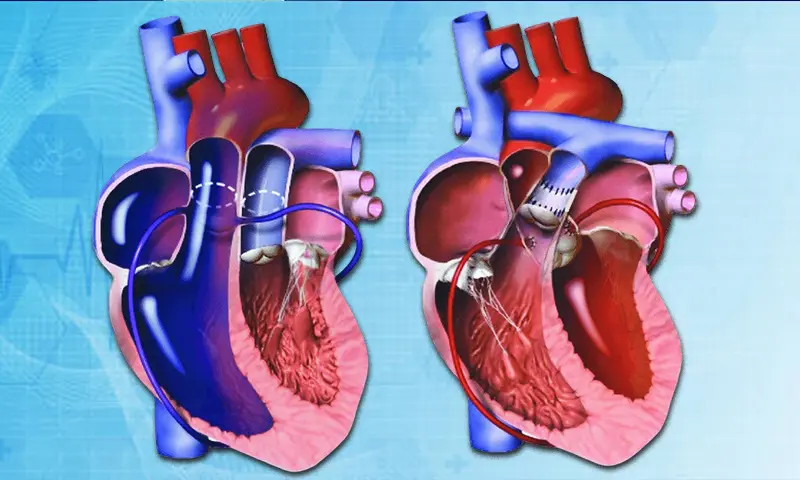 Arterial Switch Surgery 